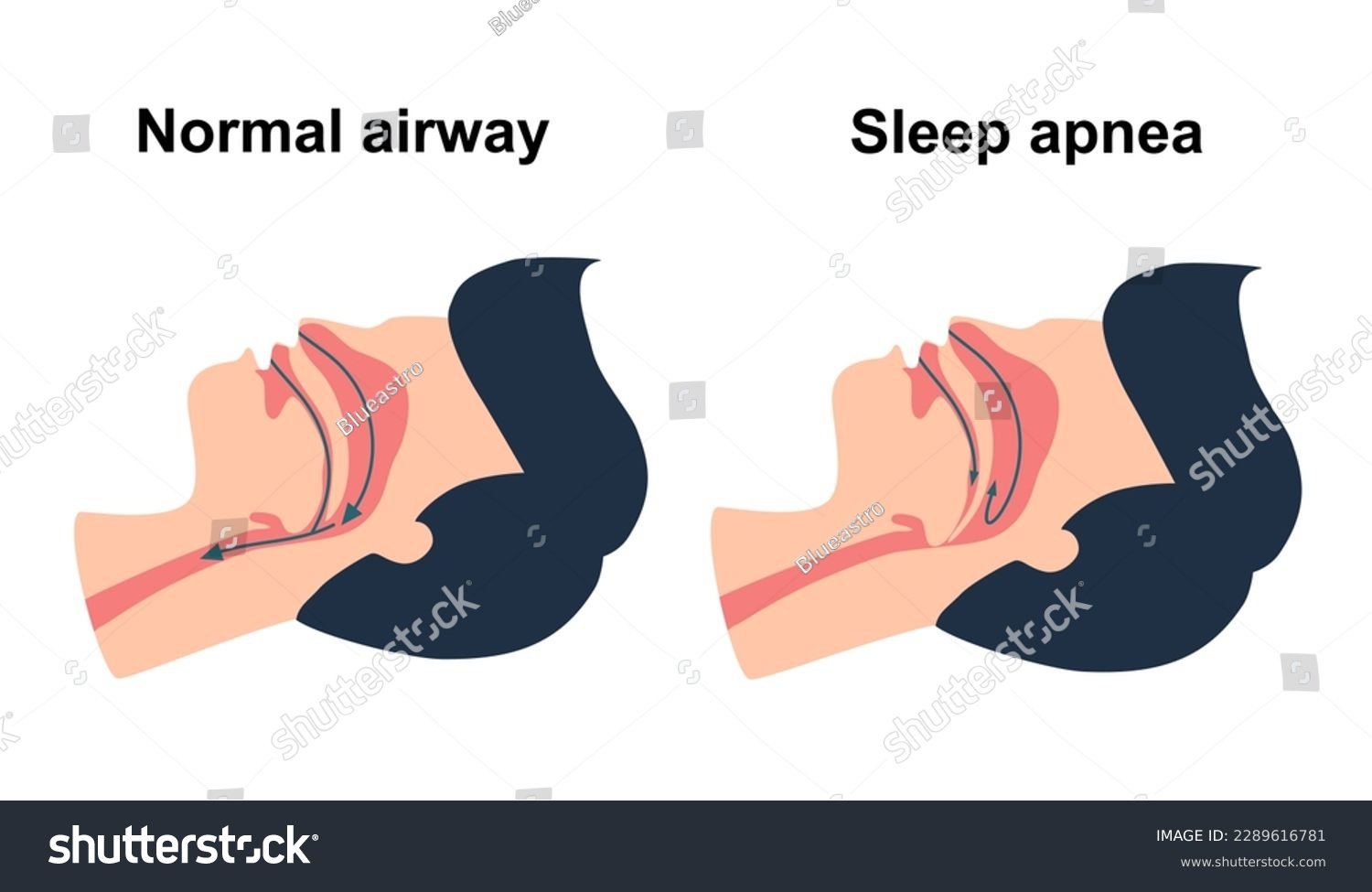 sleep apenea
